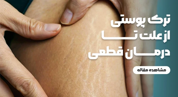 ترک‌های پوستی: از علت تا درمان قطعی – هر آنچه باید بدانید